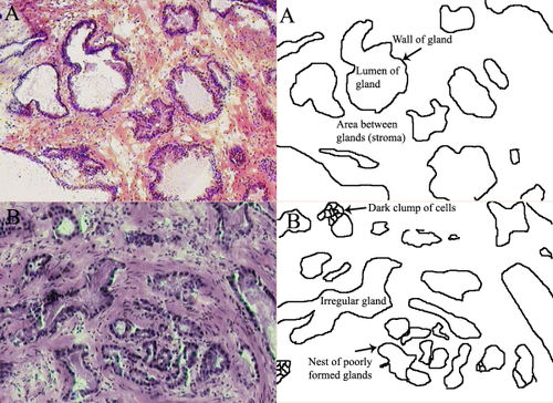 Normal prostate (A) and prostate cancer (B). In prostate cancer, the regular glands of the normal prostate are replaced by irregular glands and clumps of cells, as seen in these pictures taken through a microscope.