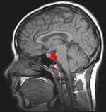 Image of the human brain. The arrow indicates the position of the hypothalamus.